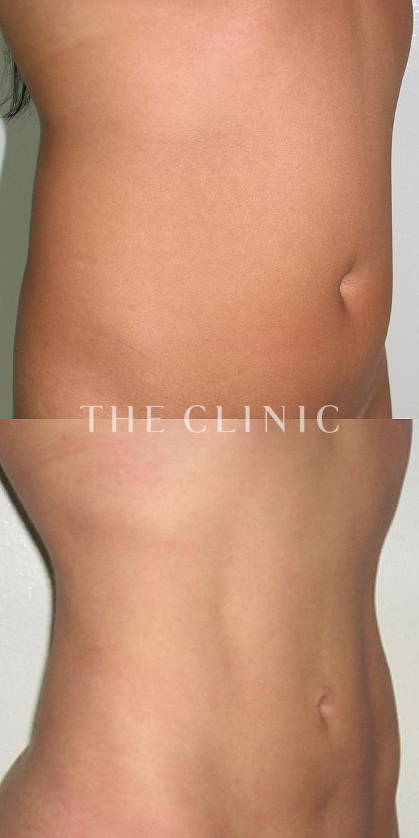 TWOPACK 陰影ある腹部の4D脂肪吸引(4Dリポ)（33歳女性）の術前・術後写真