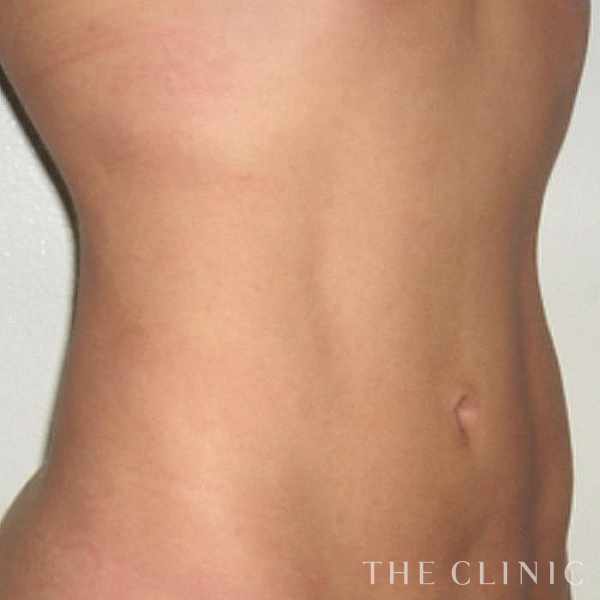 TWOPACK 陰影ある腹部の4D脂肪吸引(4Dリポ)（33歳女性）の術後写真