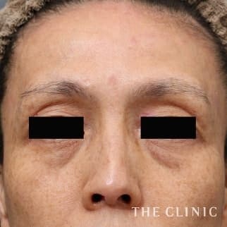 【THE CLINIC 症例画像】No.695_1_目の下のクマ_マイクロCRF注入(顔の脂肪注入)