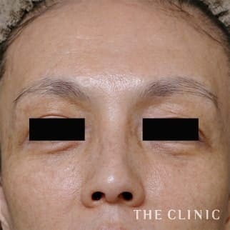 【THE CLINIC 症例画像】No.695_2_目の下のクマ_マイクロCRF注入(顔の脂肪注入)