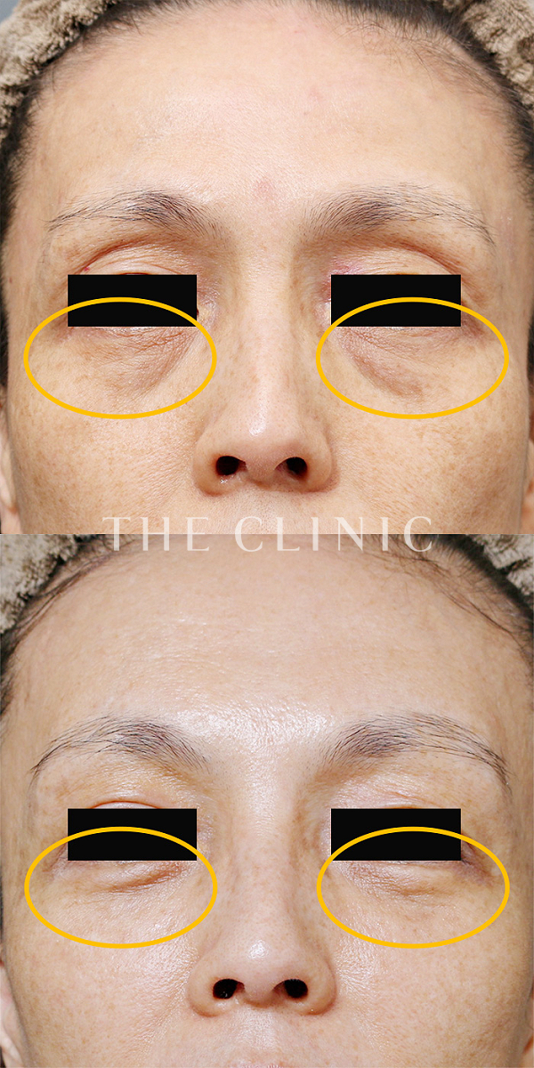 目の下のクマのマイクロCRF注入(顔の脂肪注入)（52歳女性）の術前・術後写真