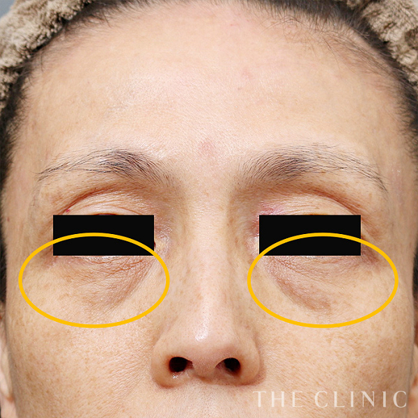 目の下のクマのマイクロCRF注入(顔の脂肪注入)（52歳女性）の術前写真