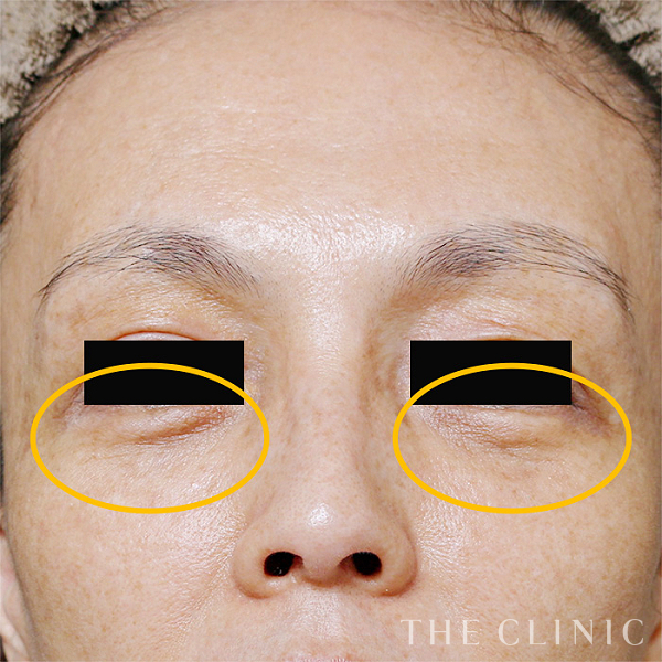 目の下のクマのマイクロCRF注入(顔の脂肪注入)（52歳女性）の術後写真