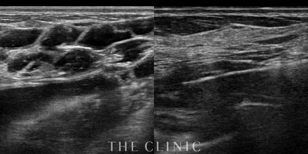 アクアフィリング(アクアリフト)豊胸除去の術前/術後