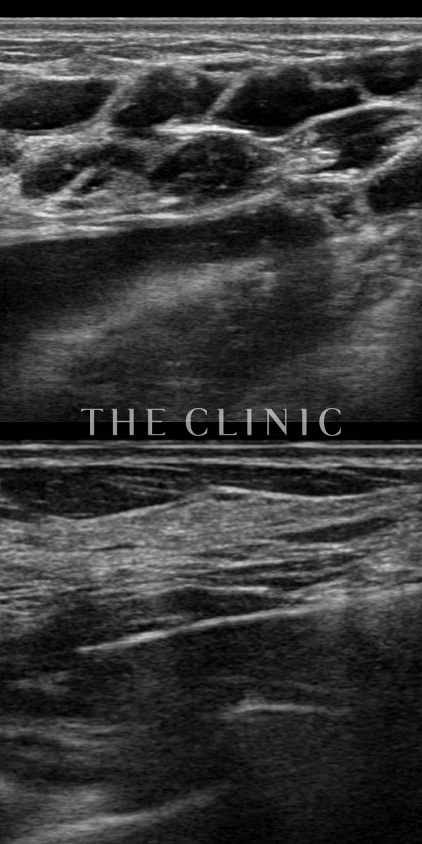 不自然な形のアクアフィリング(アクアリフト)豊胸除去（35歳女性）の術前・術後写真