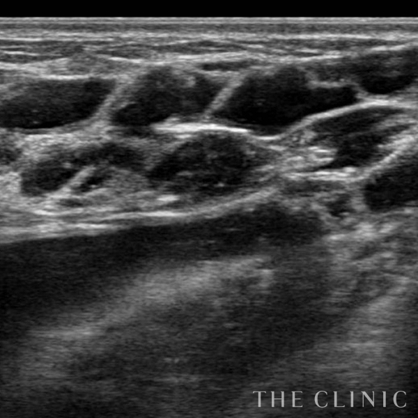 不自然な形のアクアフィリング(アクアリフト)豊胸除去（35歳女性）の術前写真