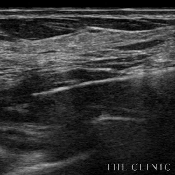 不自然な形のアクアフィリング(アクアリフト)豊胸除去（35歳女性）の術後写真