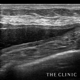 不自然な形のアクアフィリング(アクアリフト)豊胸除去のモニター(30代)術前症例画像