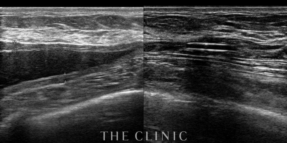 アクアフィリング(アクアリフト)豊胸除去の術前/術後