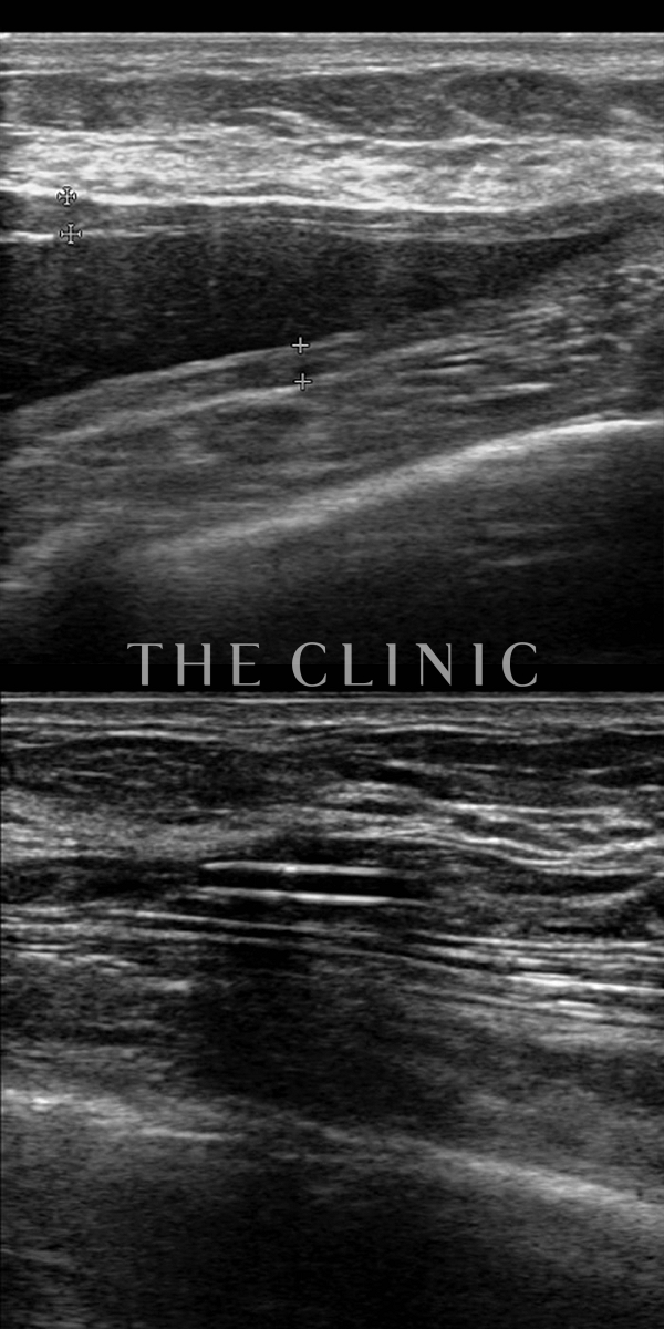 不自然な形のアクアフィリング(アクアリフト)豊胸除去（35歳女性）の術前・術後写真