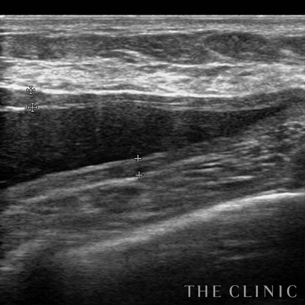 不自然な形のアクアフィリング(アクアリフト)豊胸除去（35歳女性）の術前写真