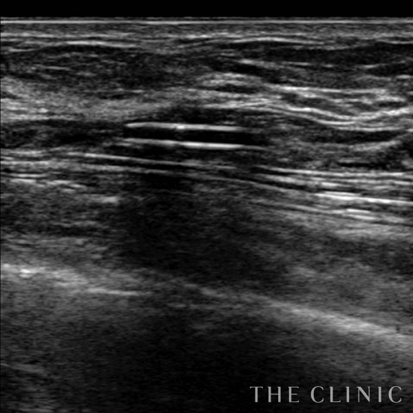 不自然な形のアクアフィリング(アクアリフト)豊胸除去（35歳女性）の術後写真