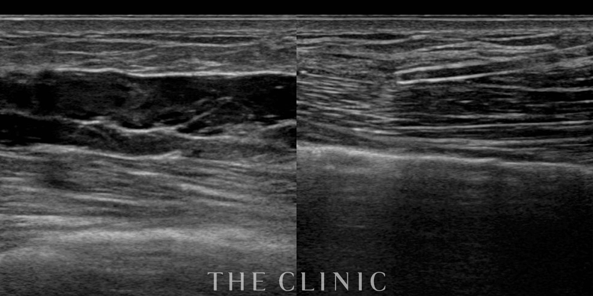 アクアフィリング(アクアリフト)豊胸除去の術前/術後
