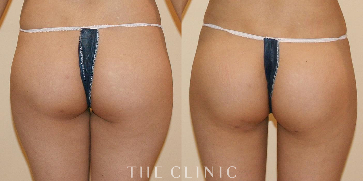 4D脂肪吸引(4Dリポ)の術前/術後