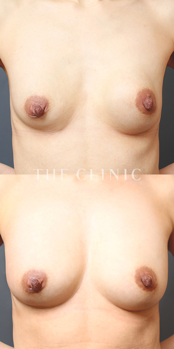 ボリュームアップの豊胸ヒアルロン酸除去（37歳女性）の術前・術後写真