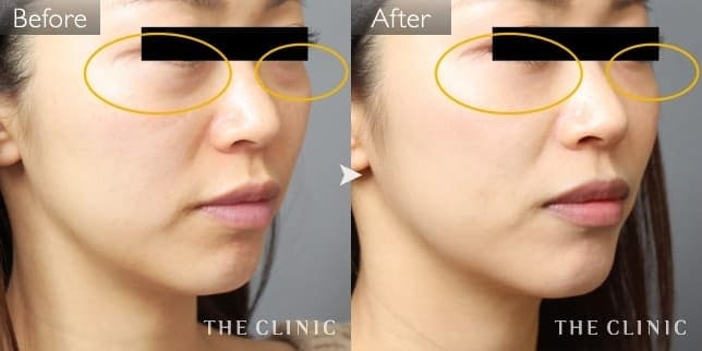 目の下のクマ(女性/30歳)