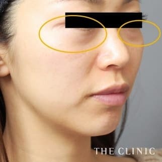 【THE CLINIC 症例画像】No.708_1_目の下のクマ_SRF注入(顔の脂肪注入)
