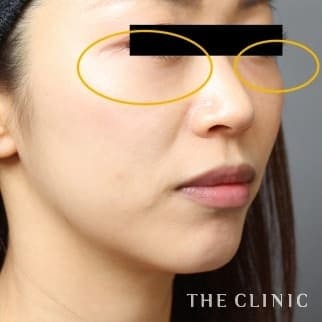【THE CLINIC 症例画像】No.708_2_目の下のクマ_SRF注入(顔の脂肪注入)