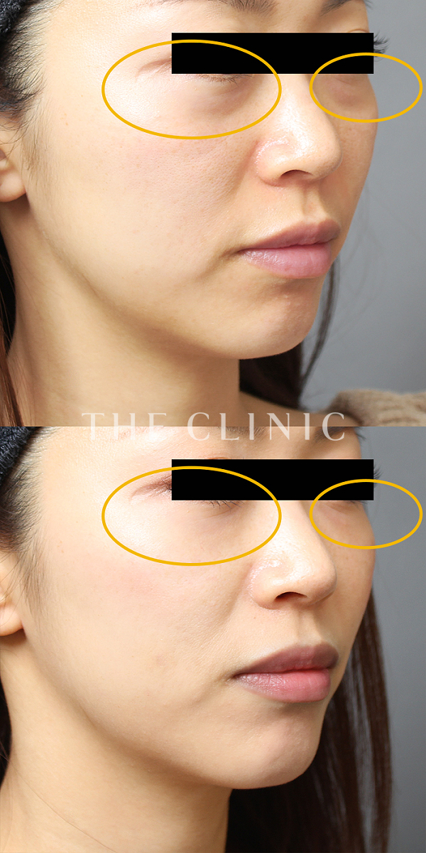 目の下のクマのSRF注入(顔の脂肪注入)（30歳女性）の術前・術後写真