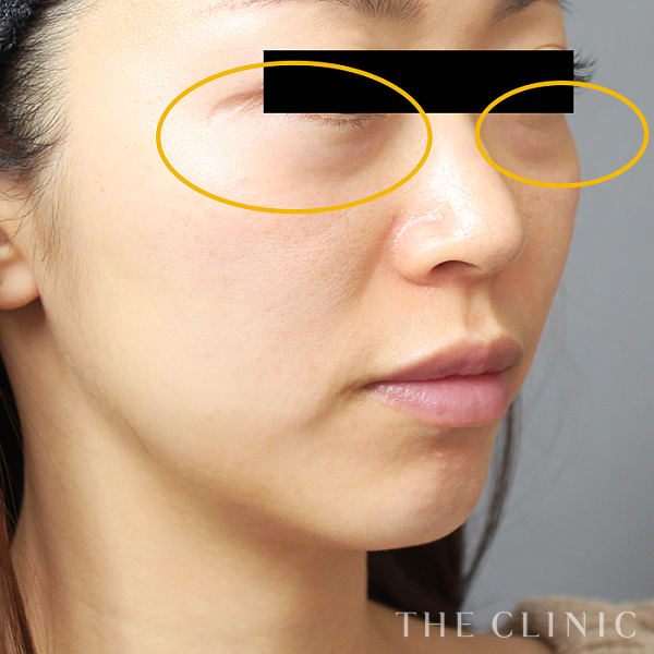 目の下のクマのSRF注入(顔の脂肪注入)（30歳女性）の術前写真