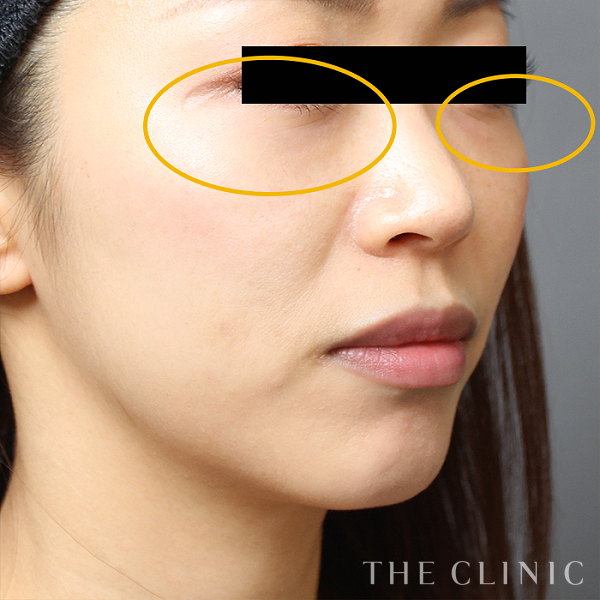 目の下のクマのSRF注入(顔の脂肪注入)（30歳女性）の術後写真