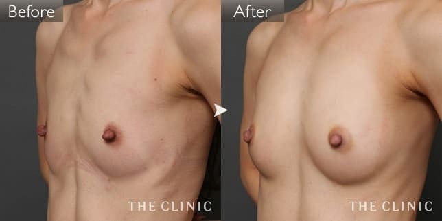 豊胸・胸の整形 ボリュームアップ/左右のバランス 症例写真