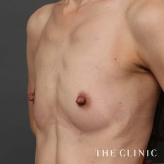 【THE CLINIC 症例画像】No.711_1_ボリュームアップ_コンデンスビブラ豊胸