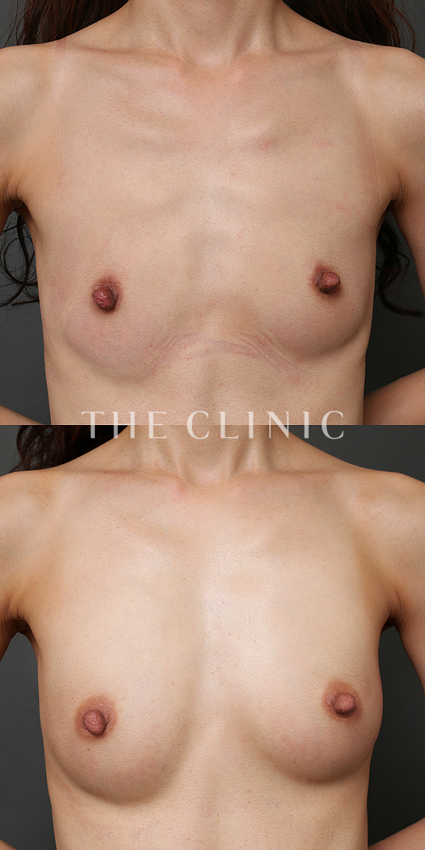 ボリュームアップのコンデンスビブラ豊胸（36歳女性）の術前・術後写真