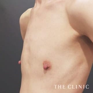 【THE CLINIC 症例画像】No.714_1_ボリュームアップ_BRAVA×コンデンスリッチ豊胸(執刀医:)