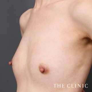 【THE CLINIC 症例画像】No.714_2_ボリュームアップ_BRAVA×コンデンスリッチ豊胸(執刀医:)