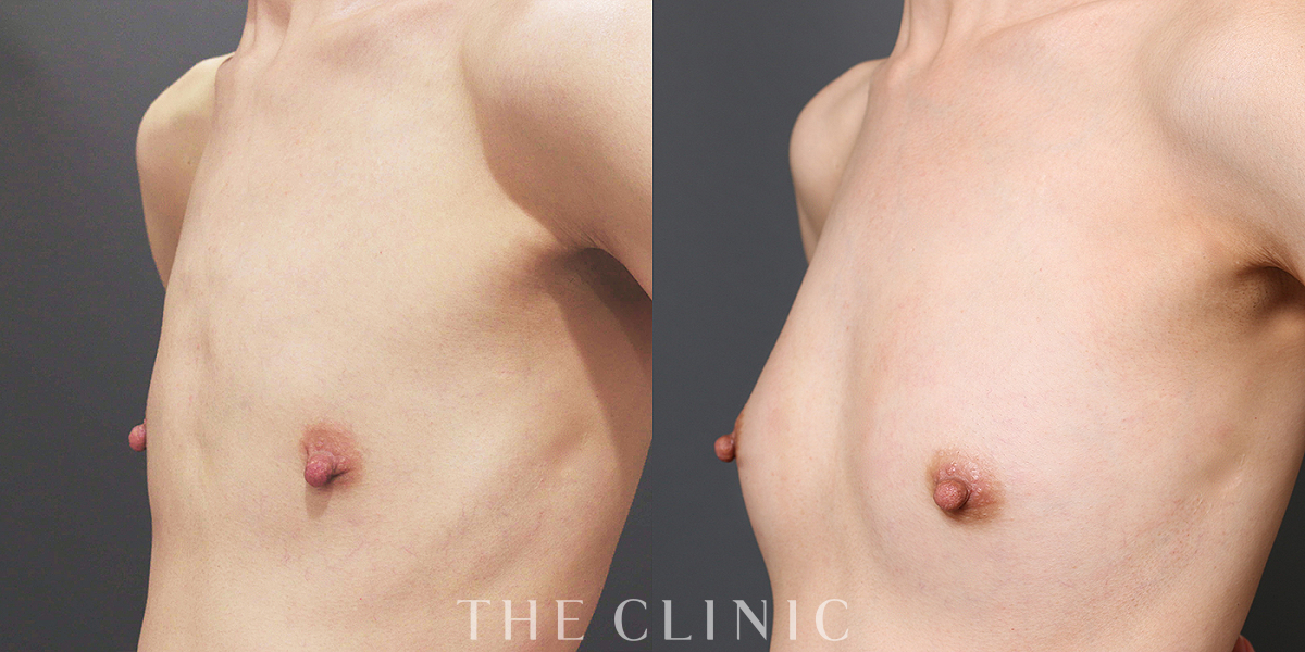 BRAVA×コンデンスリッチ豊胸の術前/術後