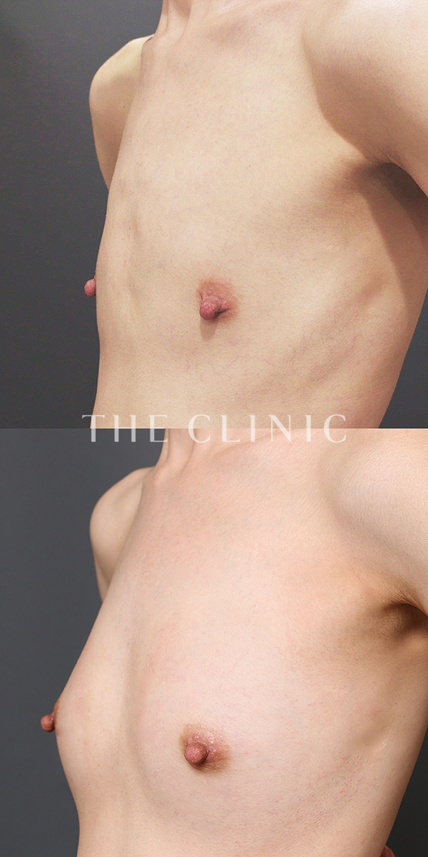 ボリュームアップのBRAVA×コンデンスリッチ豊胸（39歳女性）の術前・術後写真