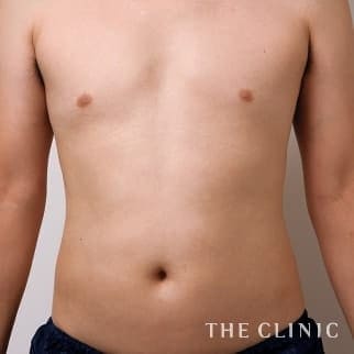 腰・ウエスト／SIX PACK ６つに割れた腹筋のベイザー4D(男性のシックスパック脂肪吸引)のモニター（40代）術前症例画像