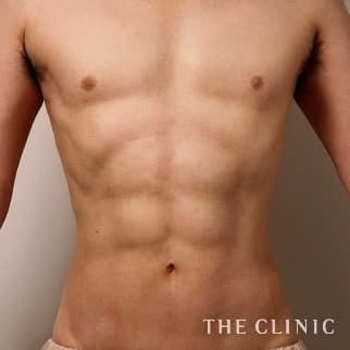 腰・ウエスト／SIX PACK ６つに割れた腹筋のベイザー4D(男性のシックスパック脂肪吸引)のモニター（40代）術後症例画像