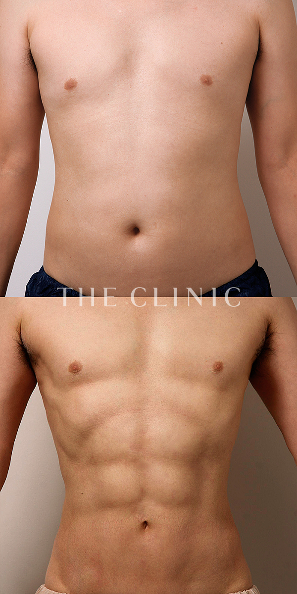 腰・ウエスト・SIX PACK ６つに割れた腹筋のベイザー4D(男性のシックスパック脂肪吸引)（47歳男性）の術前・術後写真