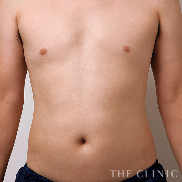 腰・ウエスト・SIX PACK ６つに割れた腹筋のベイザー4D(男性のシックスパック脂肪吸引)（47歳男性）の術前写真