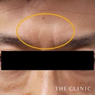 【THE CLINIC 症例画像】No.71_1_眉間のシワ_マイクロCRF注入(顔の脂肪注入)