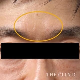 【THE CLINIC 症例画像】No.71_2_眉間のシワ_マイクロCRF注入(顔の脂肪注入)