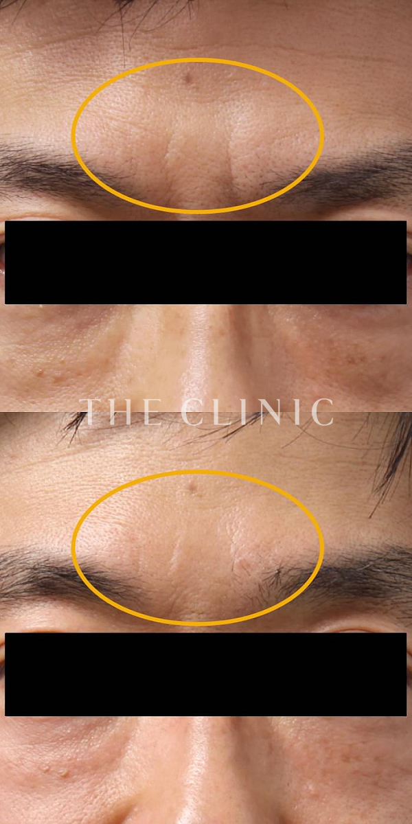 眉間のシワのマイクロCRF注入(顔の脂肪注入)（53歳男性）の術前・術後写真