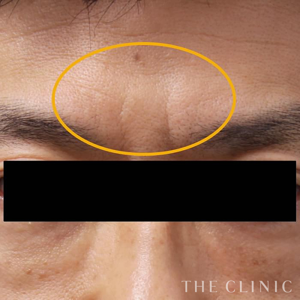 眉間のシワのマイクロCRF注入(顔の脂肪注入)（53歳男性）の術前写真