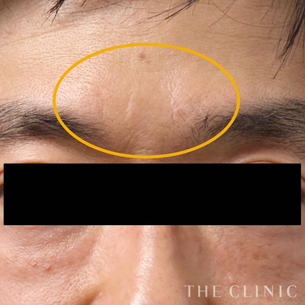 眉間のシワのマイクロCRF注入(顔の脂肪注入)（53歳男性）の術後写真