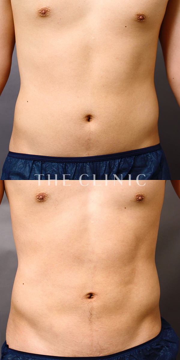 腹部の360脂肪吸引®（25歳男性）の術前・術後写真
