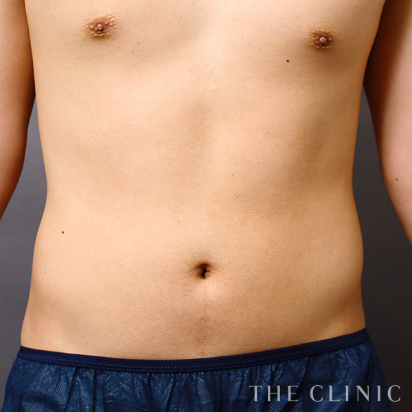 腹部の360脂肪吸引®（25歳男性）の術前写真