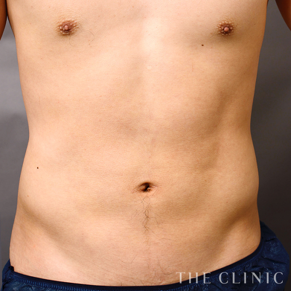 腹部の360脂肪吸引®（25歳男性）の術後写真