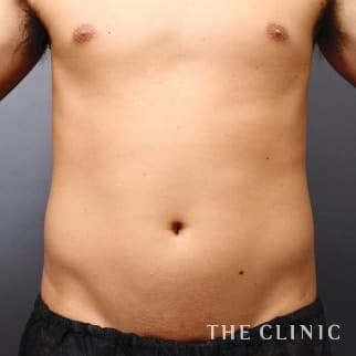 腰・ウエスト/SIX PACK 6つに割れた腹筋のベイザー4D(男性のシックスパック脂肪吸引)のモニター(30代)術前症例画像