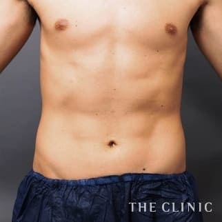 腰・ウエスト／SIX PACK ６つに割れた腹筋のベイザー4D(男性のシックスパック脂肪吸引)のモニター（30代）術後症例画像