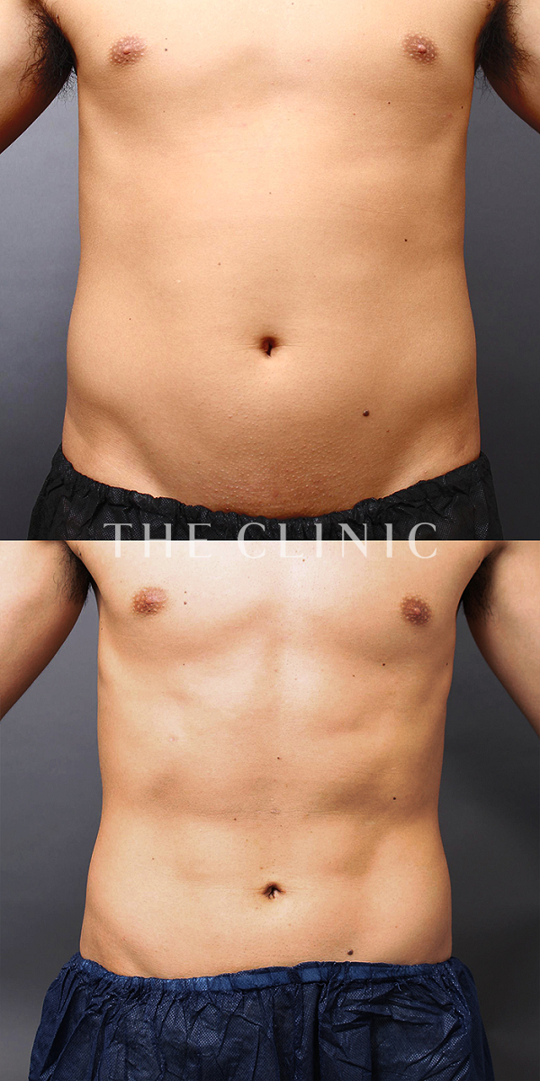 腰・ウエスト・SIX PACK ６つに割れた腹筋のベイザー4D(男性のシックスパック脂肪吸引)（31歳男性）の術前・術後写真