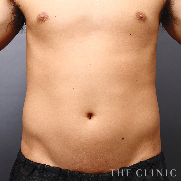 腰・ウエスト・SIX PACK ６つに割れた腹筋のベイザー4D(男性のシックスパック脂肪吸引)（31歳男性）の術前写真
