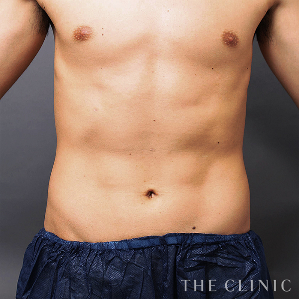 腰・ウエスト・SIX PACK ６つに割れた腹筋のベイザー4D(男性のシックスパック脂肪吸引)（31歳男性）の術後写真