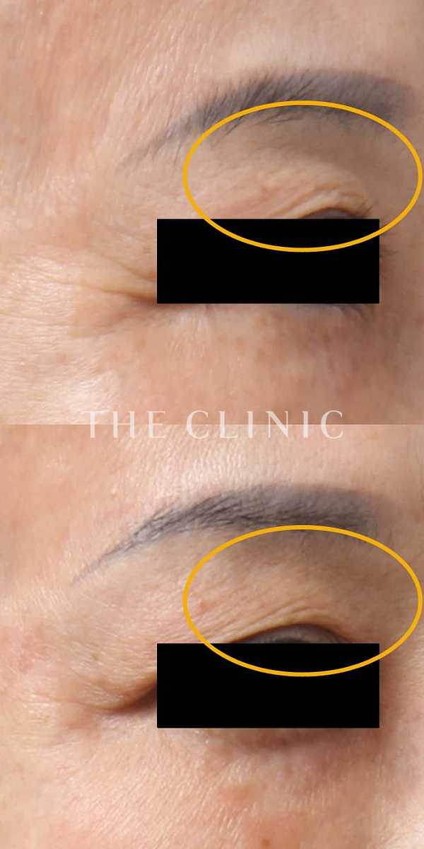 目の上のくぼみのマイクロCRF注入(顔の脂肪注入)（61歳女性）の術前・術後写真